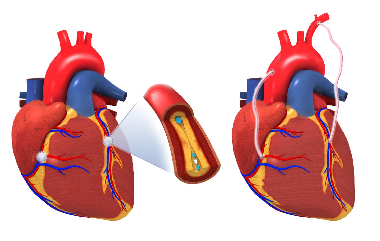 Coronary Artery Bypass Surgeon Hyderabad