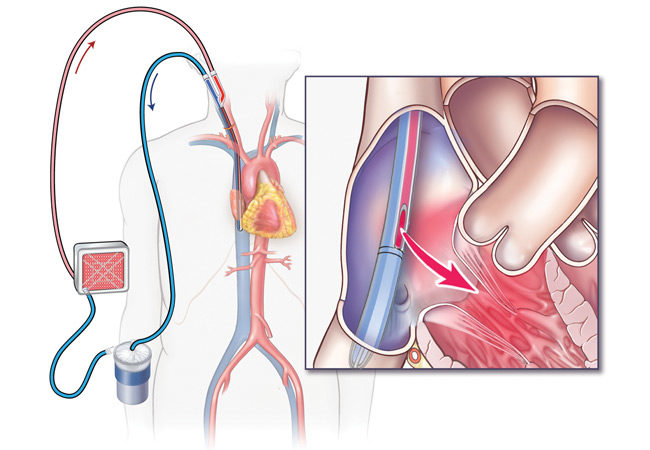Mechanical Circulatory Support & ECMO