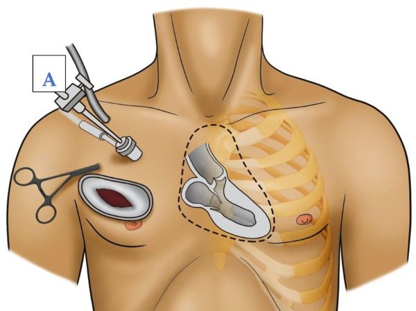 Minimally invasive cardiothoracic surgery Hyderabad